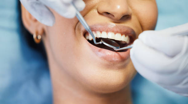 Best Emergency Dentist for Lost Fillings or Crowns in Annapolis, MD