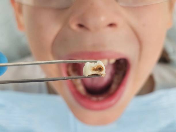 Best Emergency Dentist for Special Needs Patients in Annapolis, MD